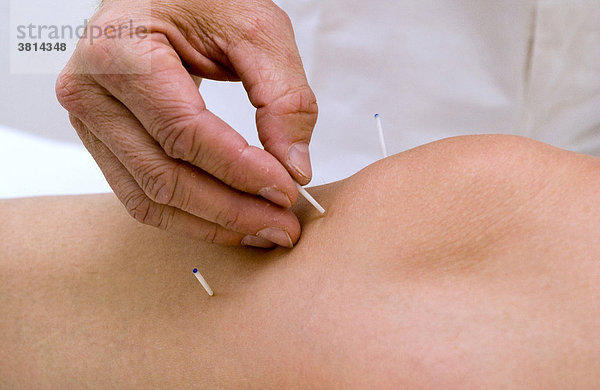 Arzt setzt Akupunktur Nadeln am Knie einer Frau