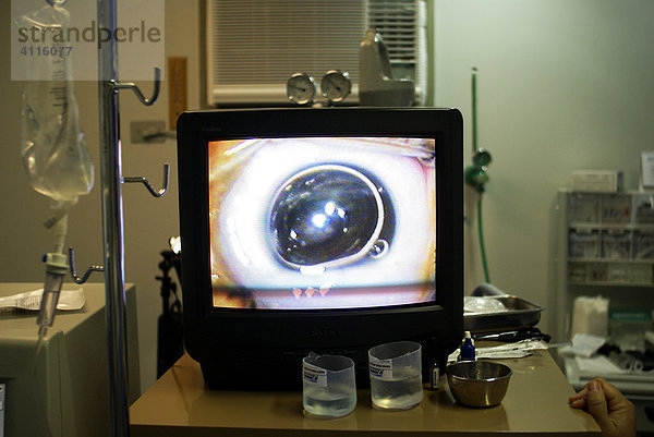 Augenoperation (Grauer Star  Katarakt) am Bildschirm des Operationssaales  Recife  Brasilien