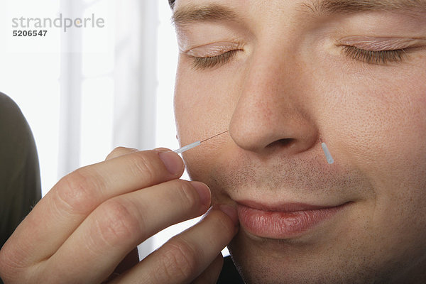 Akupunktur  Mann bekommt Nadeln im Gesicht gesetzt