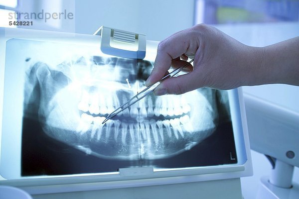 Hand zeigt mit Pinzette auf Gebiss-Röntgenaufnahme beim Zahnarzt