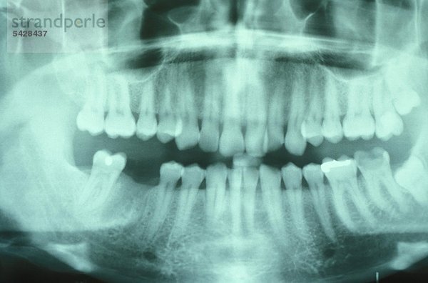 Gebiss-Röntgenaufnahme mit Zahnlücken und eingewachsenen Weisheitszähnen