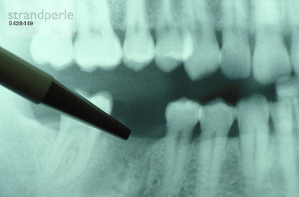 Kugelschreiber zeigt auf Gebiss-Röntgenaufnahme mit Zahnlücke