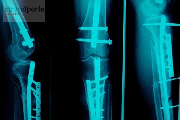 Röntgenbilder mit Vielfachknochenbrüche und Nagelungen an Ober- und Unterschenkel nach Motorradunfall Die Aufnahmen zeigen auch verschiedene Stadien des Behandlungsprozesses