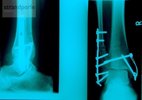 Röntgenaufnahme eines Sprunggelenkverrenkungsbruchs mit Nagelung