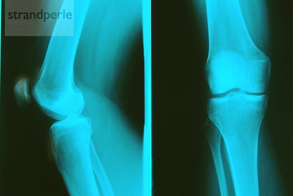 Röntgenbild eines Knies ohne Befund