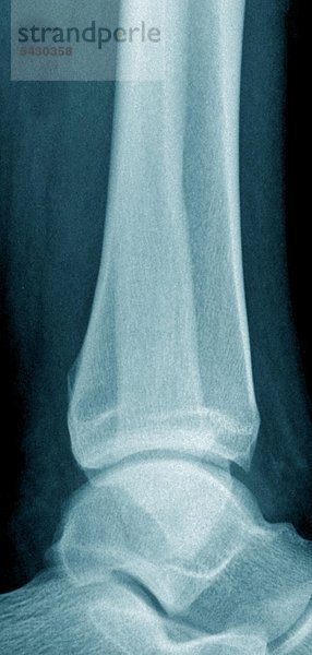 Röntgenfoto einer chirurgischen Praxis . Das Röntgenbild zeigt : Sprunggelenk seitlich