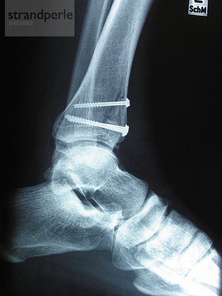 Unterschenkelfraktur von Schienbein fixiert mit 3 Schrauben - Röntgenbild