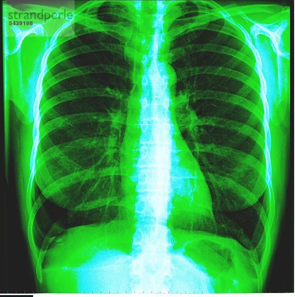 Röntgenbild eines Brustkorbs