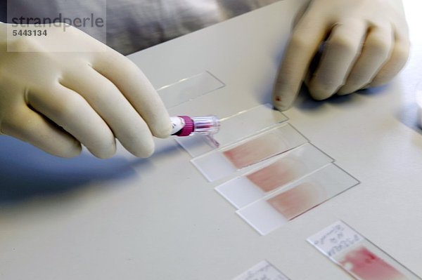 In einem modernen Kliniklabor werden verschiedene Blutproben analysiert - eine Laborantin mit Latexhandschuhen bringt Blutproben auf einen Objektträger auf für die Prüfung unter dem Mikroskop