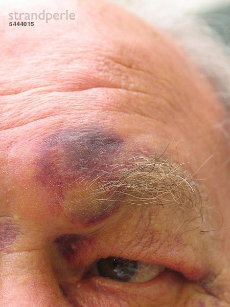 ein älterer Mann mit blauen Flecken im Gesicht nach einem Sturz im Wohnzimmer