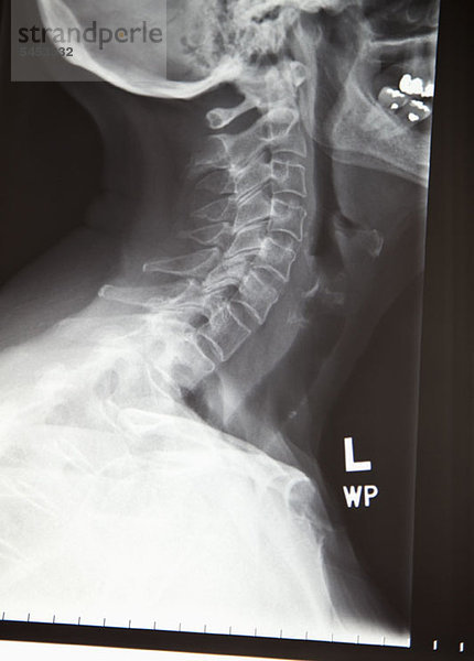 Nahaufnahme eines Röntgenbildes eines menschlichen Halses