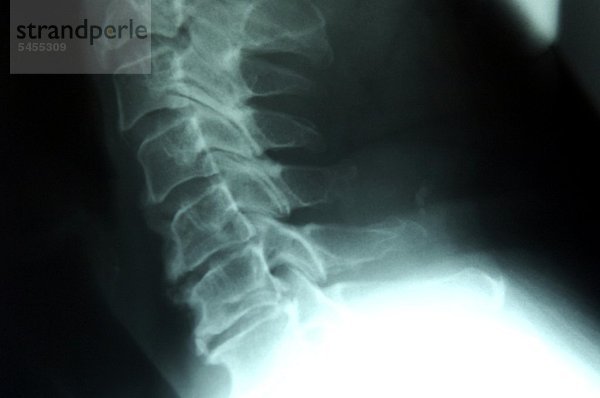 Röntgenbild eines weiblichen Lendenwirbels