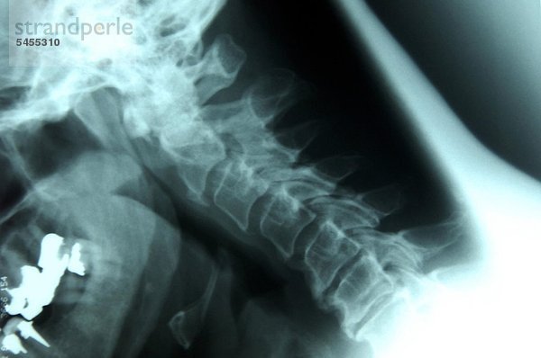 Röntgenbild eines weiblichen Lendenwirbels