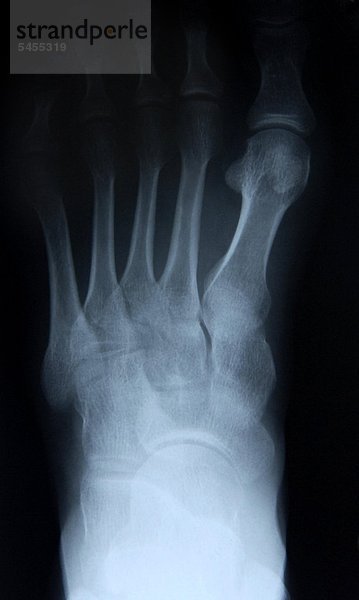 Röntgenbild eines Fußes