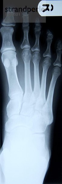 Röntgenbild eines Fußes