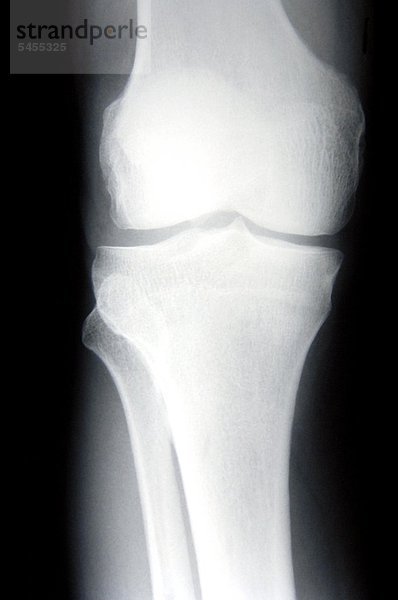 Röntgenbild eines Kniegelenks