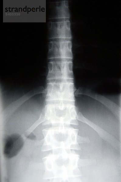 Röntgenbild des unteren Rückenwirbels