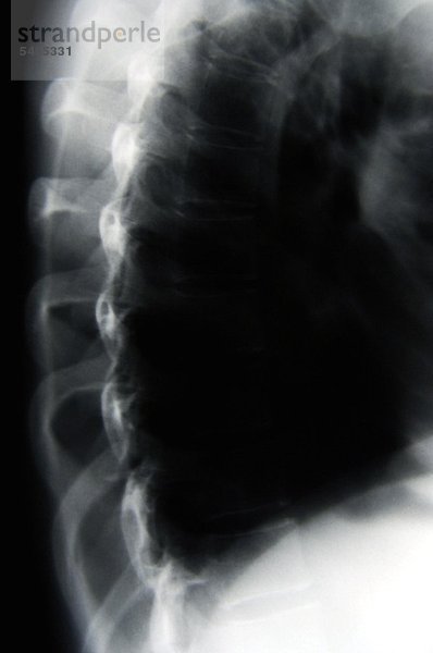Röntgenbild eines Brustkorbs
