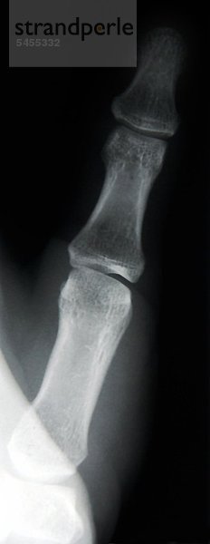 Röntgenbild eines Fingers