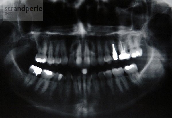 Röntgenbild eines Kiefers mit Zähnen