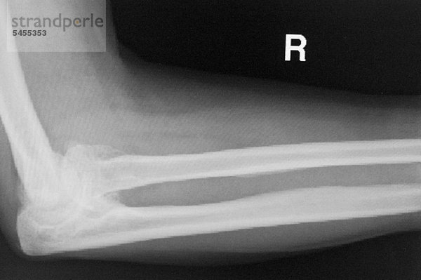 Röntgenbild eines Armes