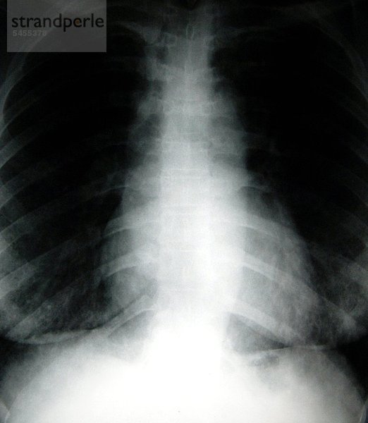 Röntgenbild einer Rippe