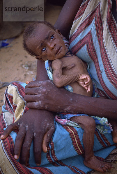 Abgemagert Baby im Flüchtlingslager in 1992  Mogadischu  Somalia  Afrika