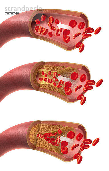 Arterie mit roten Blutkörperchen und Arteriosklerose