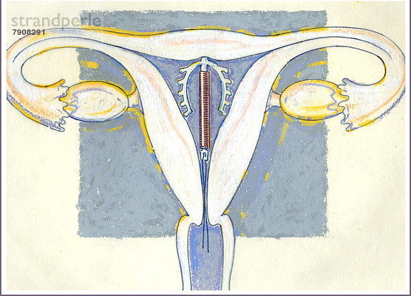 Intrauterinpessar in der Gebärmutter