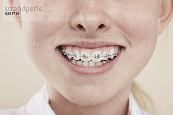 Ein lächelndes Mädchen mit einer Zahnspange  Nahaufnahme des Mundes.