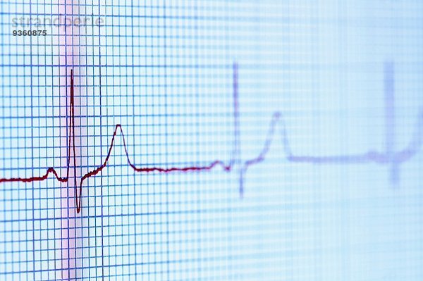 Elektrokardiogramm (Pulsspur) auf einem digitalen Tablett-Bildschirm dargestellt