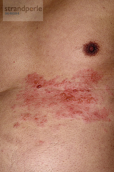 Gürtelrose oder Herpes zoster im Brustbereich bei einem 56-jährigen Mann  mehrere Dermatome sind betroffen