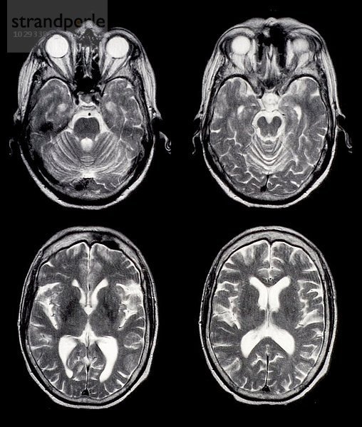 Axiale Gehirn-MRT-Aufnahmen einer normalen 65-jährigen Frau. Einige der gesehenen Strukturen sind die Augen  die Augenmuskulatur  die Schläfenlappen  die Hinterhauptslappen  das Kleinhirn  der Hirnstamm und die Kammern.
