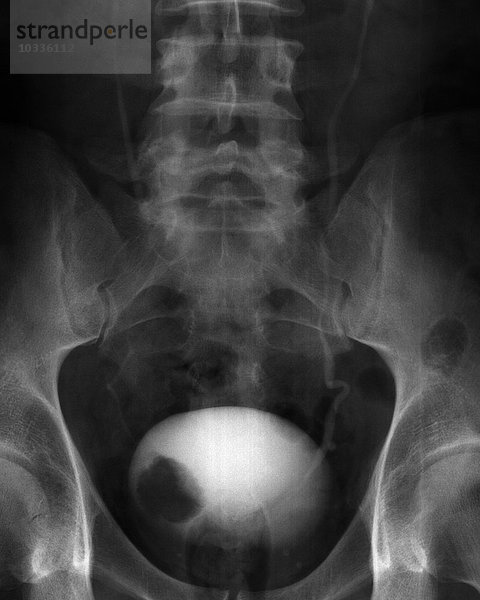 Röntgenbild eines ca. drei Zentimeter großen Rohrkolbentumors