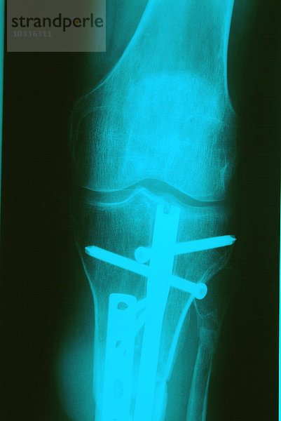 Röntgenplatte  Mehrfachfraktur mit Stiften nach Motorradunfall