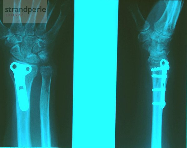 Röntgenbild zum Speichenbruch mit Tapeplatte