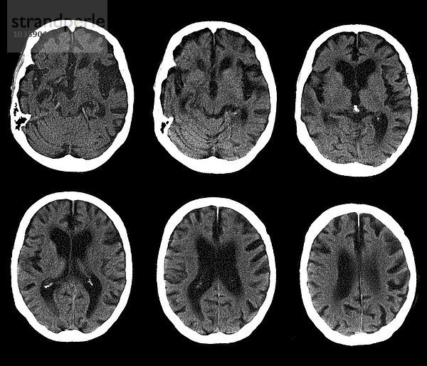 Gehirn mit Alzheimer-Krankheit  CT-Scan