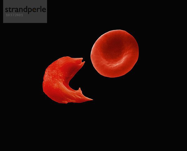 Normale rote Blutkörperchen und eine Sichelzelle. Sichelzellenanämie ist eine vererbte Blutkrankheit. In normalen roten Blutkörperchen transportiert Hämoglobin Sauerstoff von der Lunge zu den Organen und Geweben und bringt Kohlendioxid zurück in die Lunge. Bei der Sichelzellenanämie ist das Hämoglobin defekt. Nachdem es den Sauerstoff zu den Organen und Geweben transportiert hat  können sich einige Zellen zusammenballen und stäbchenartige Strukturen bilden  wodurch das rote Blutkörperchen steif wird und die Sichelform annimmt. SEM X7000 bei 4-X6-