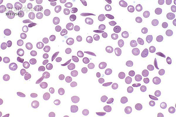 Sichelzellenkrankheit in menschlichem Blut  homozygotes Hämoglobin  mit Sichel-  Sichel- und Zielrotkörperchen  Wright-Färbung. LM X160