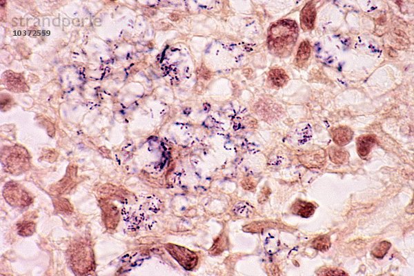 Mycobacterium leprae Bakterien  perlförmig und blau gefärbt  im Zytoplasma von Histiozyten aus einer Hautbiopsie eines Leprapatienten  FITE-Färbung. LM X400.