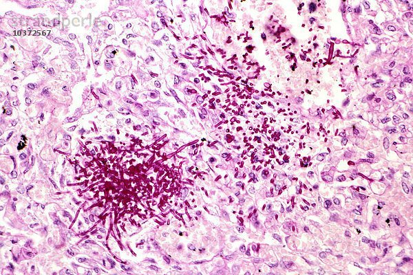 Candida albicans Hefekolonie aus der Lunge eines immungeschwächten Patienten  PAS-Färbung. LM X100
