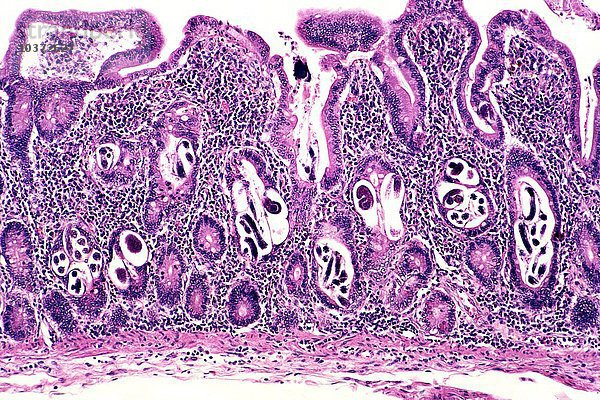 Strongyloidiasis in den Lieberkuhn-Krypten der Jejunum-Region des Dünndarms  verursacht durch den Wurm Strongyloides stercoralis  H&E-Färbung. LM X31.