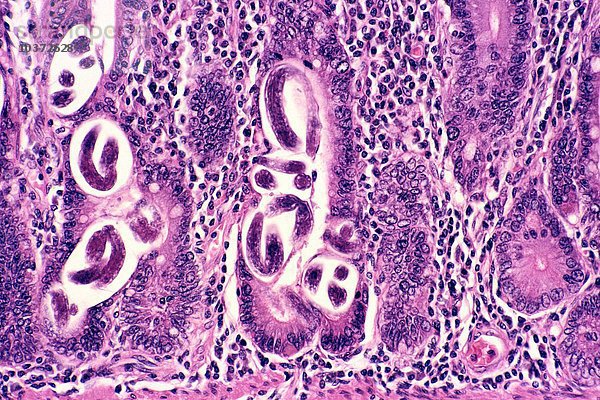 Strongyloidiasis in den Krypten von Lieberkuhn der Jejunum-Region des Dünndarms  verursacht durch den parasitischen Wurm Strongyloides stercoralis  H&E-Färbung. LM X78.