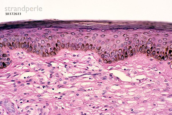 Onchozerkose in der Haut des Unterschenkels  verursacht durch den parasitären Mikrofilarienwurm Onchocerca volvulus  H&E-Färbung. LM X78.