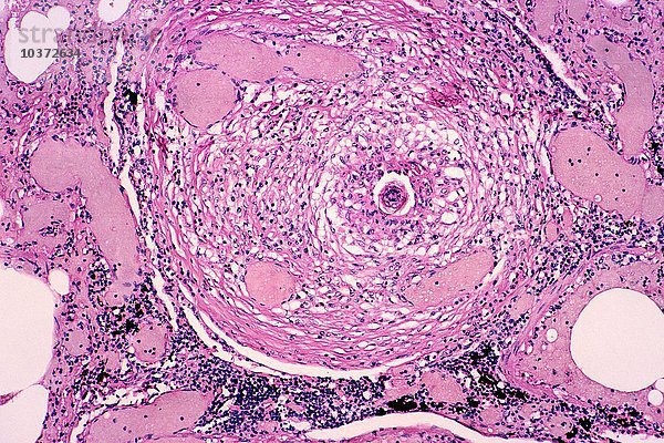 Schistosomiasis in der Lunge  oder granulomatöse Arteriitis  verursacht durch den parasitären Wurm Schistosoma mansoni  H&E-Färbung. LM X31.