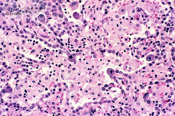 Cytomegalovirus (CMV)  Pneumonitis in der Lunge  H&E-Färbung. LM X78.