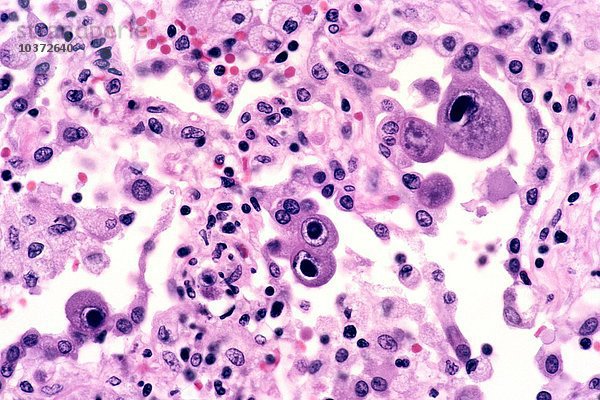 Cytomegalovirus (CMV)  Pneumonitis in der Lunge  H&E-Färbung. LM X125