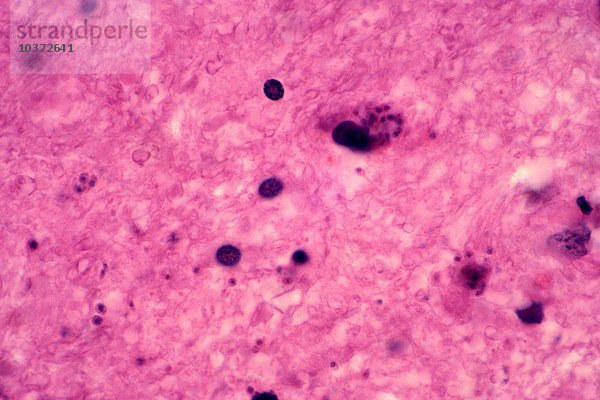 Toxoplasmose oder chronisch progressive Enzephalitis des Gehirns  verursacht durch den Protozoen Toxoplasma gondii  H&E-Färbung. LM X252.