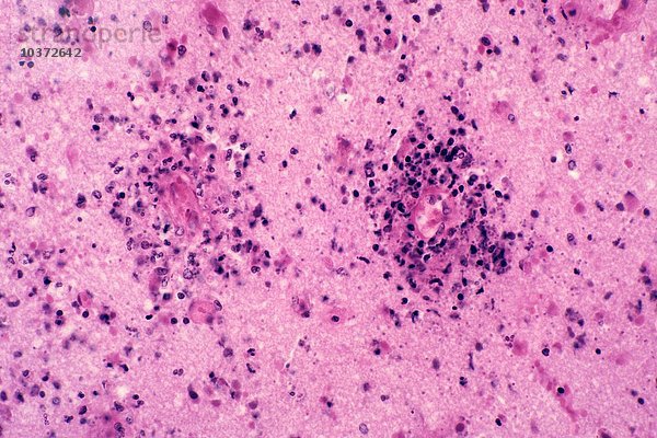 Toxoplasmose oder chronisch progressive Enzephalitis des Gehirns  verursacht durch den Protozoen Toxoplasma gondii  H&E-Färbung. LM X78