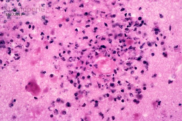 Toxoplasmose oder chronisch progressive Enzephalitis des Gehirns  verursacht durch den Protozoen Toxoplasma gondii  H&E-Färbung. LM X125.
